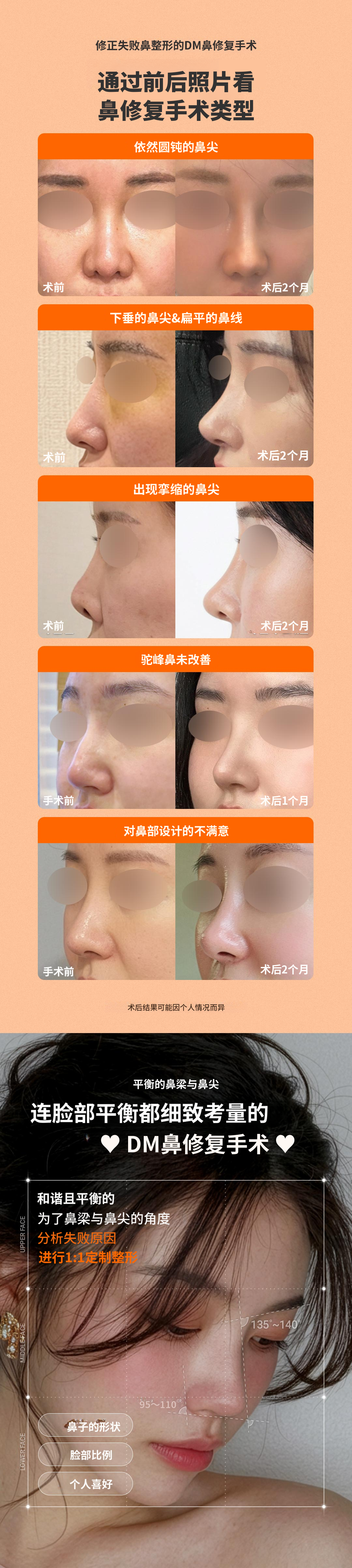 ❤ DM 鼻修复手术 ❤