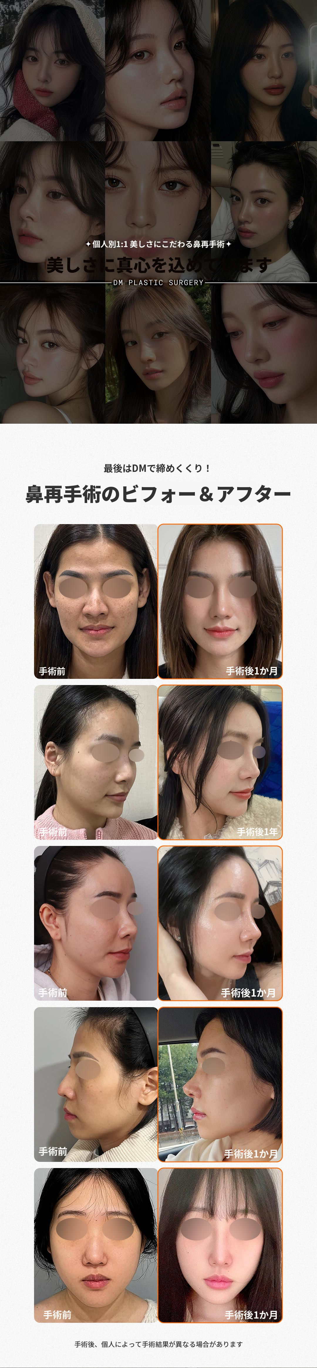 ❤ DM 鼻の再手術 ❤