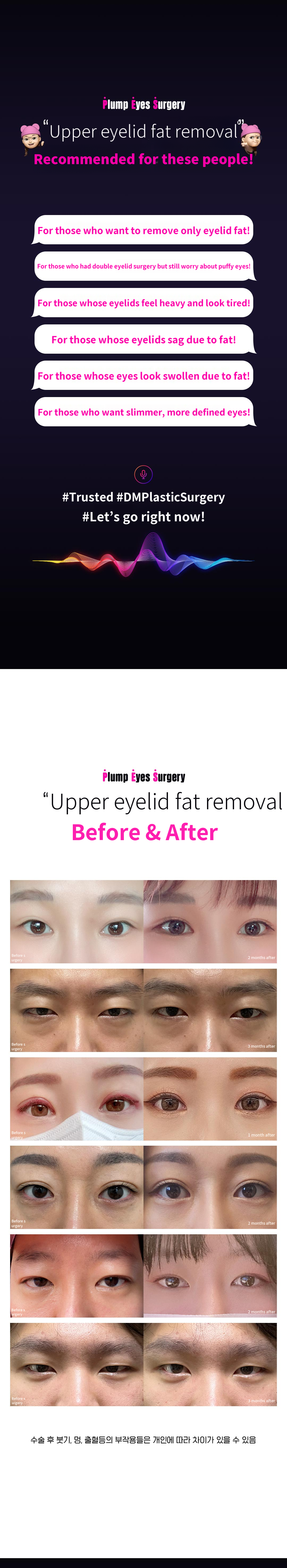 DM Eyelid Fat Removal