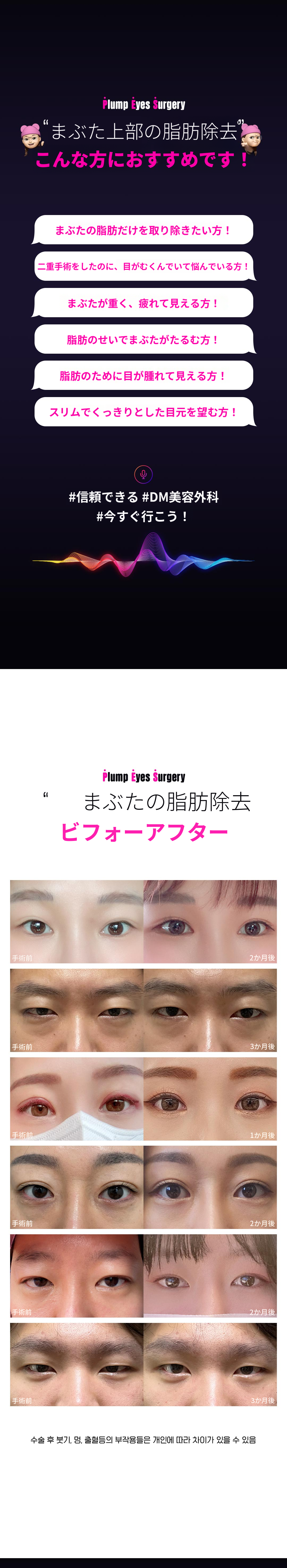 DMまぶたの脂肪除去