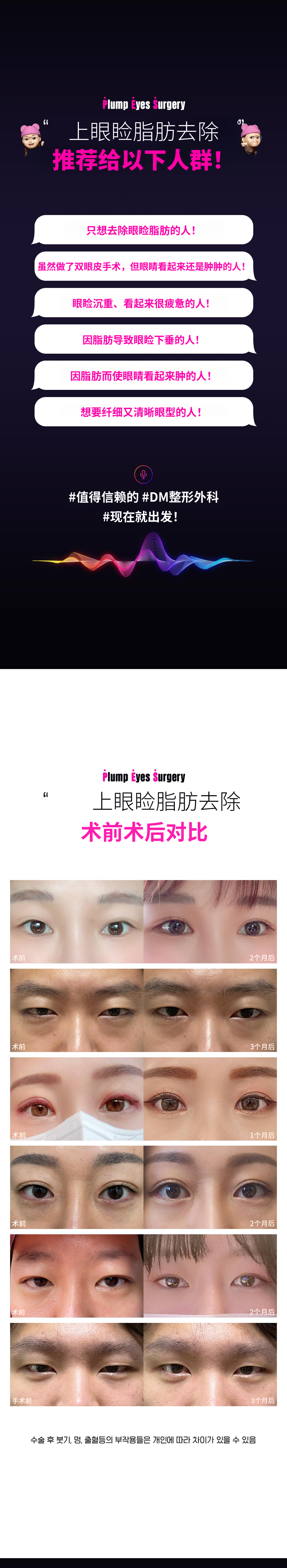 DM眼睑脂肪去除