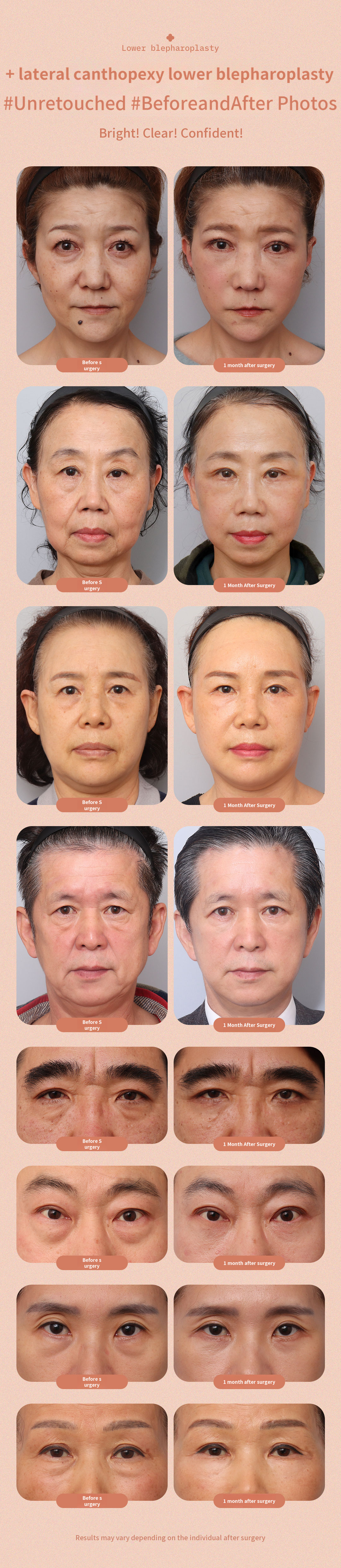 ♥DM Lateral Canthoplasty Lower Eyelid♥