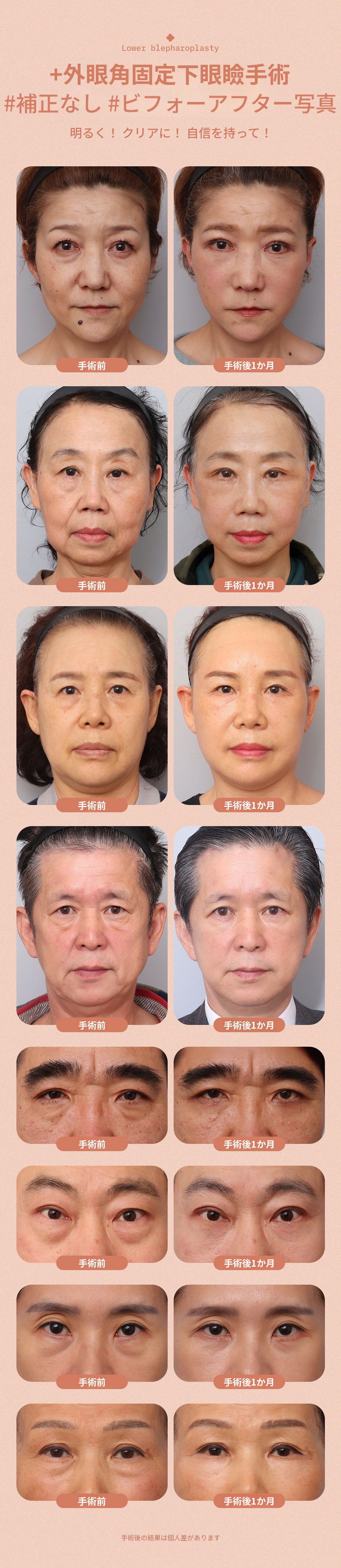 ♥DM外眼角固定下まぶた手術♥
