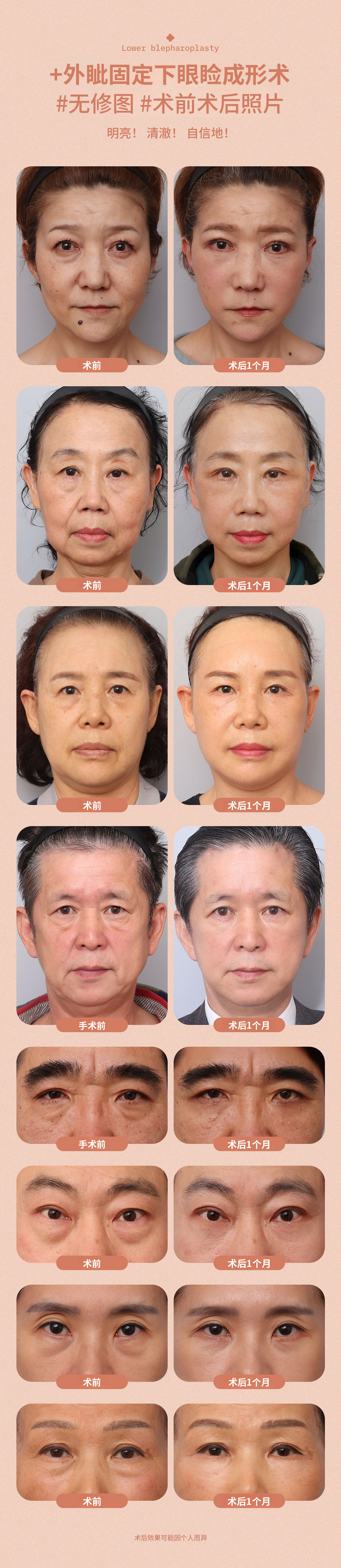 ♥DM外眼角固定下睑♥