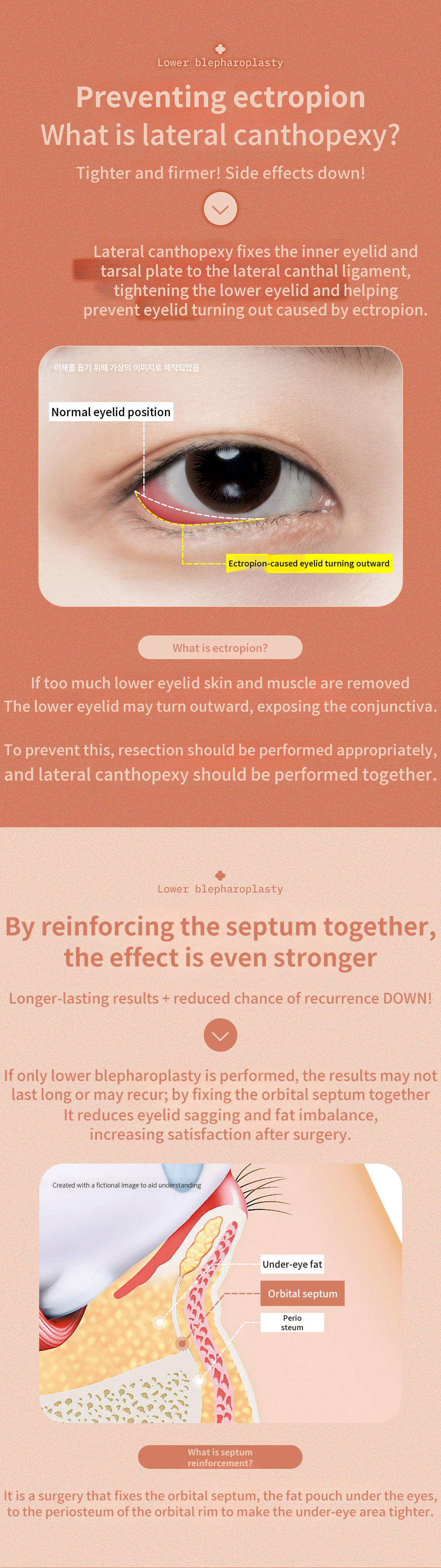 ♥DM Lateral Canthoplasty Lower Eyelid♥