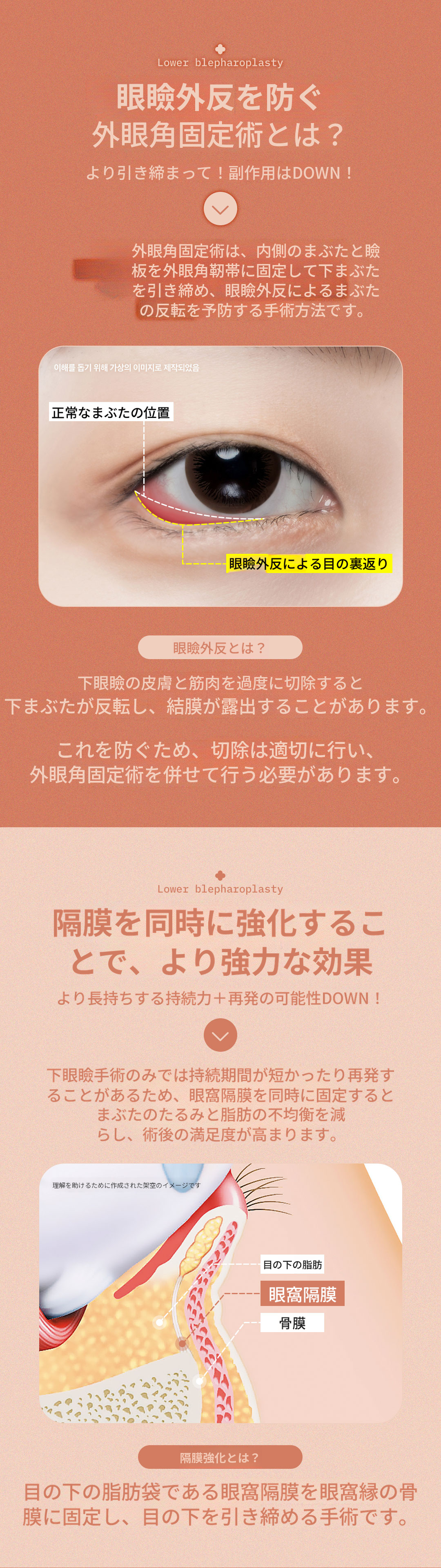 ♥DM外眼角固定下まぶた手術♥