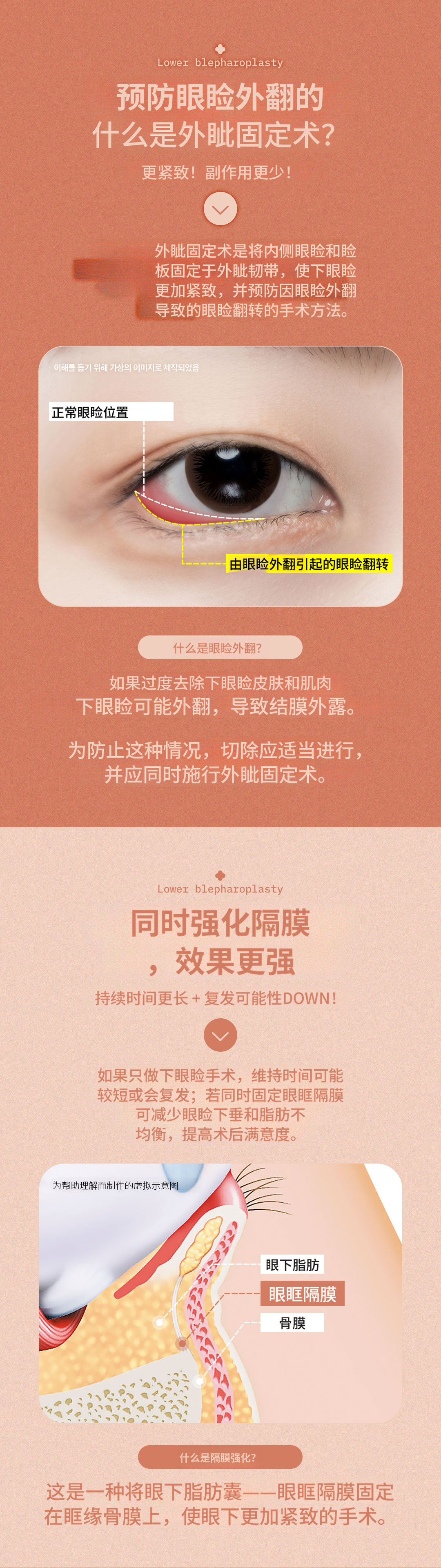 ♥DM外眼角固定下睑♥