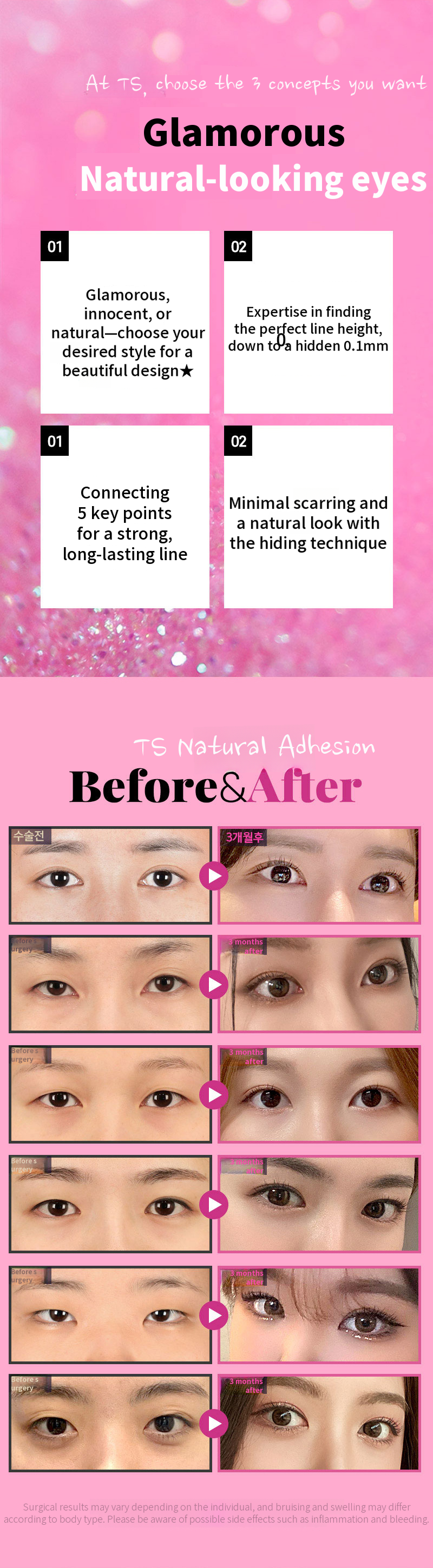 TS first eye with 3 concept natural adhesion