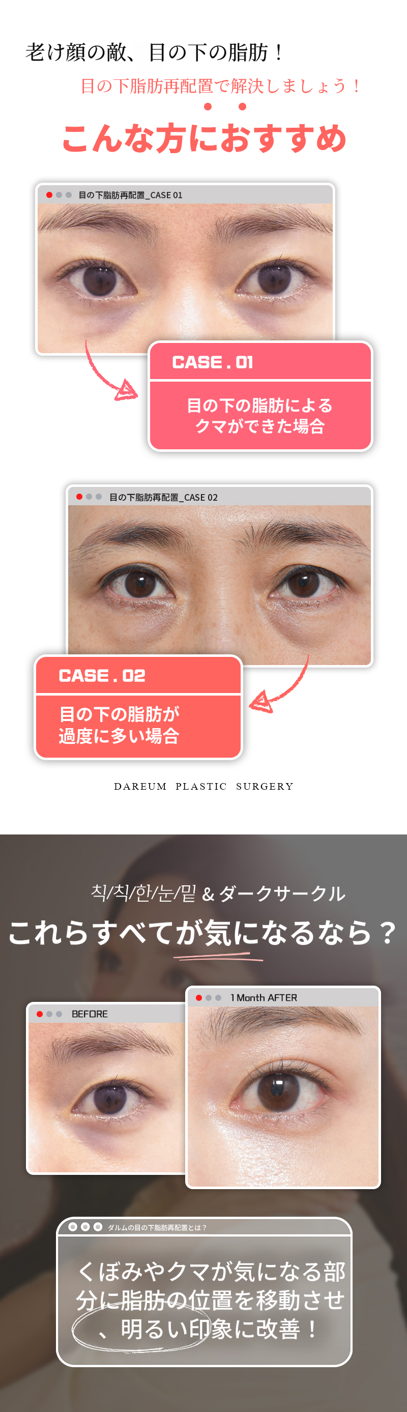 暗い目の下?別の目の下脂肪再配置