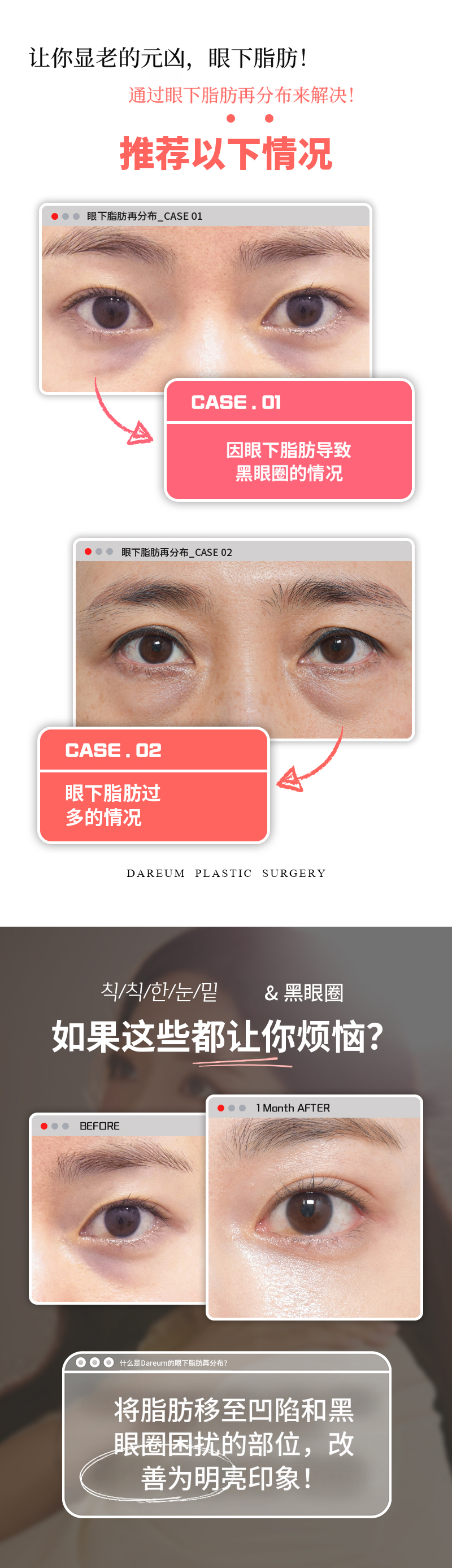 黑眼圈？眼下脂肪重塑