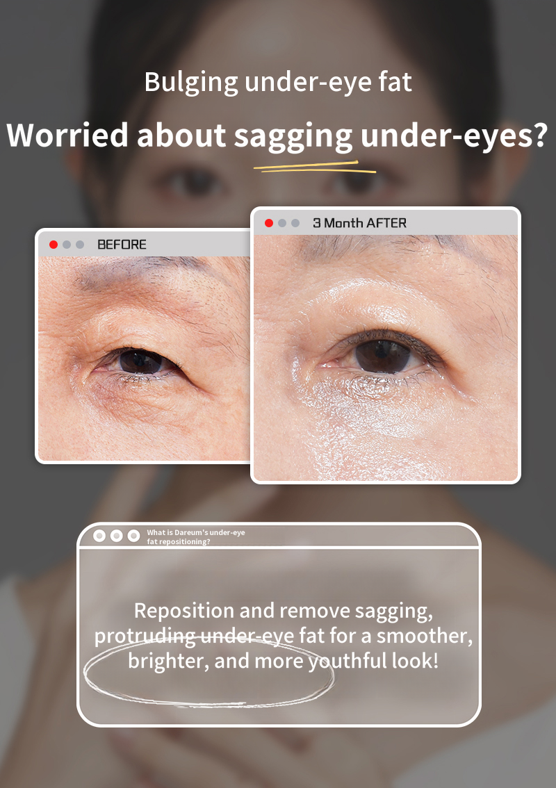 What to do about dark under-eyes? Different under-eye fat repositioning