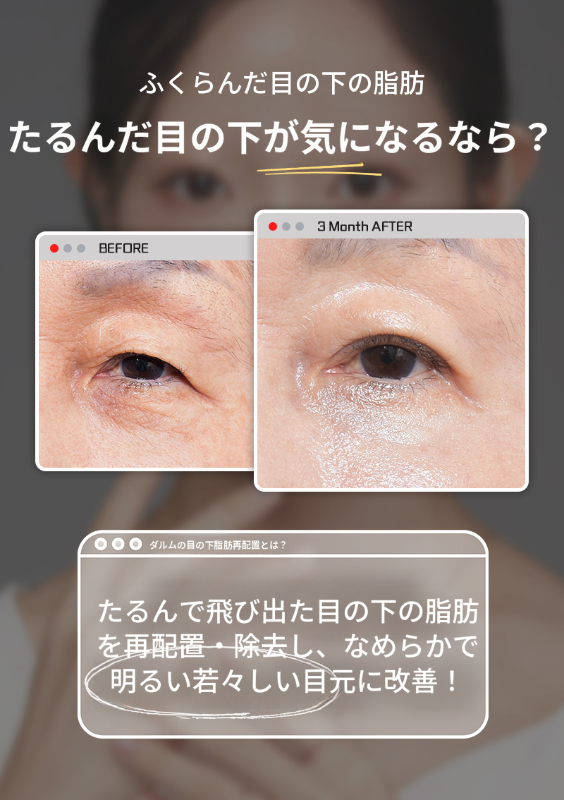 暗い目の下?別の目の下脂肪再配置