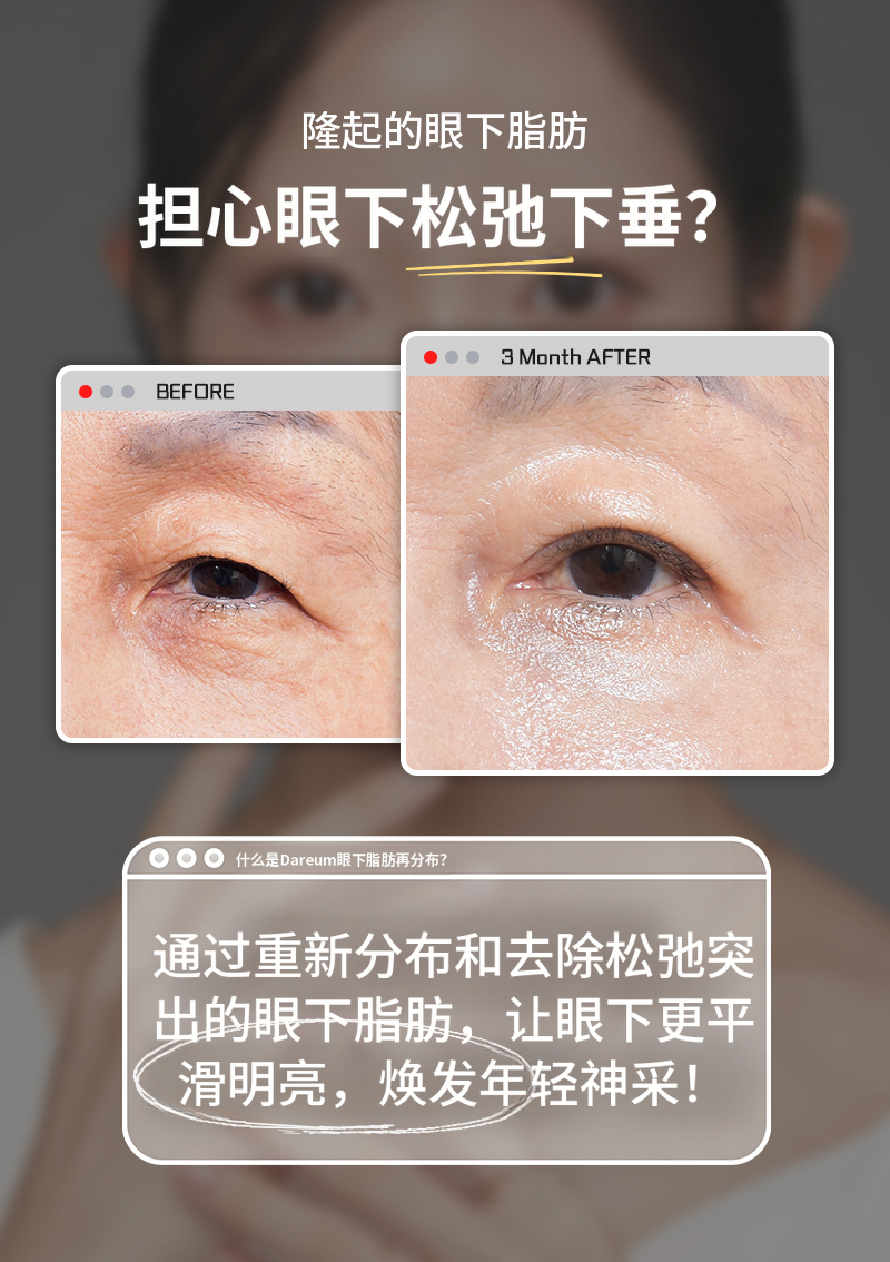 黑眼圈？眼下脂肪重塑