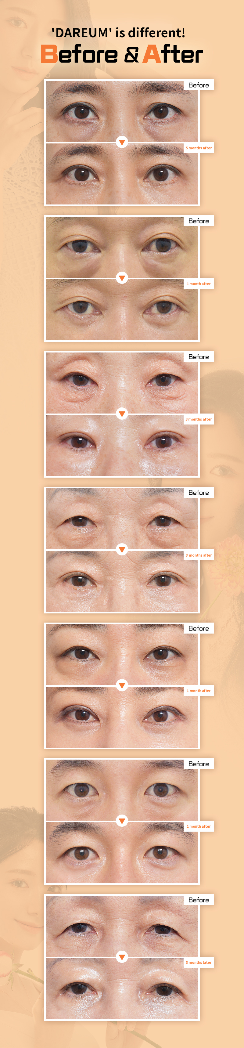 What to do about dark under-eyes? Different under-eye fat repositioning