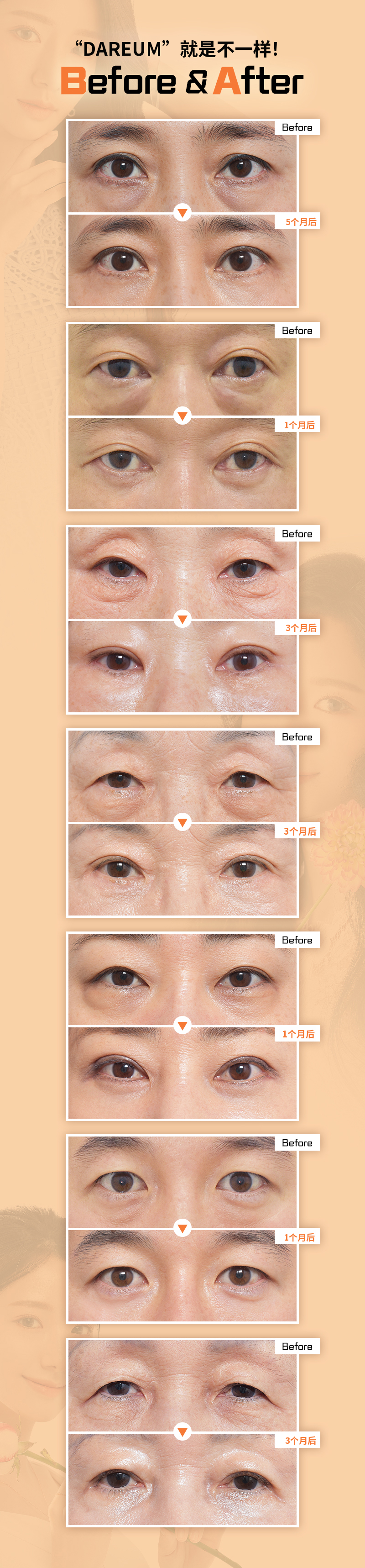 黑眼圈？眼下脂肪重塑