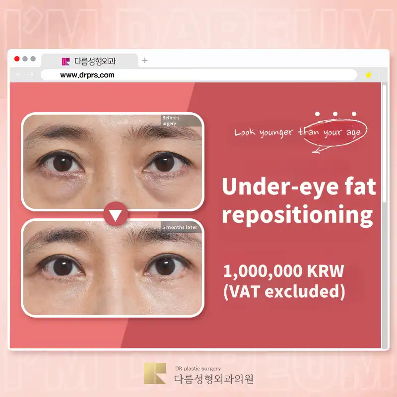 What to do about dark under-eyes? Different under-eye fat repositioning