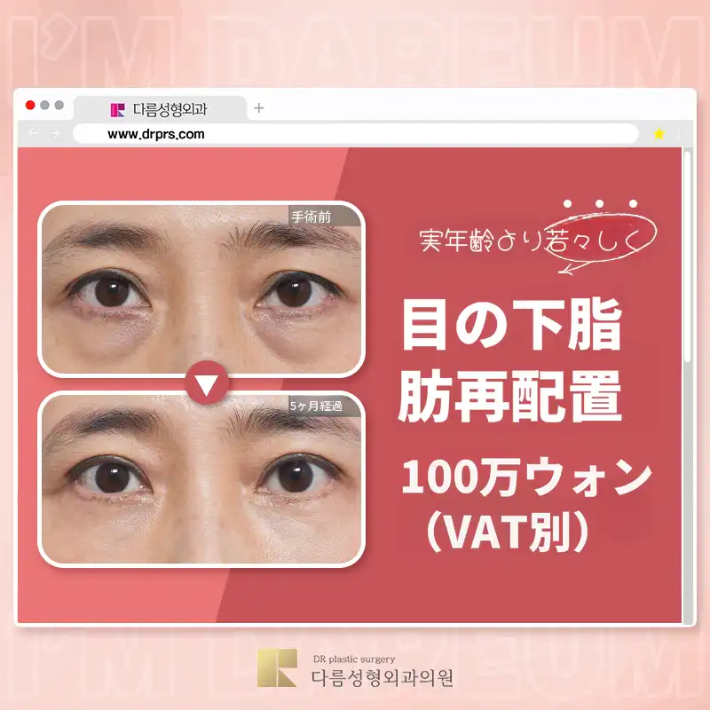 暗い目の下？別の目の下脂肪再配置