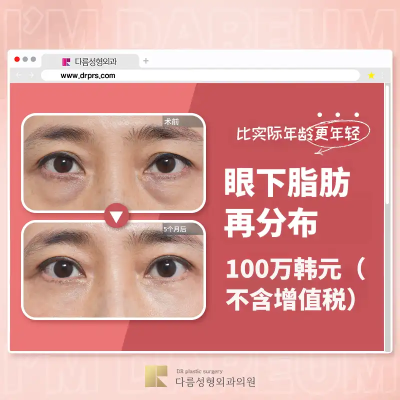 黑眼圈？眼下脂肪重塑