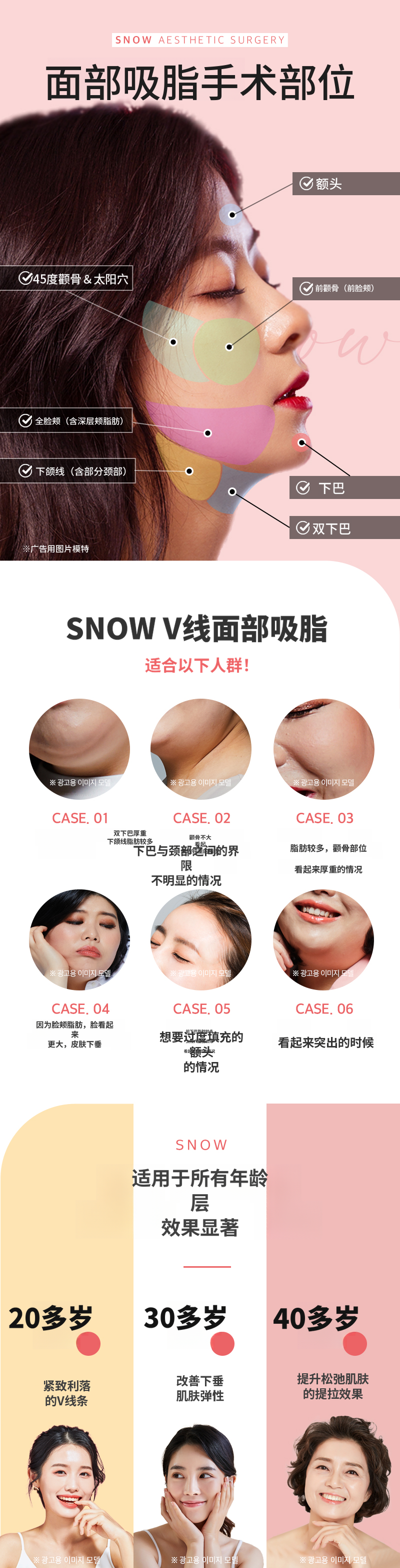 大容量面部脂肪抽吸