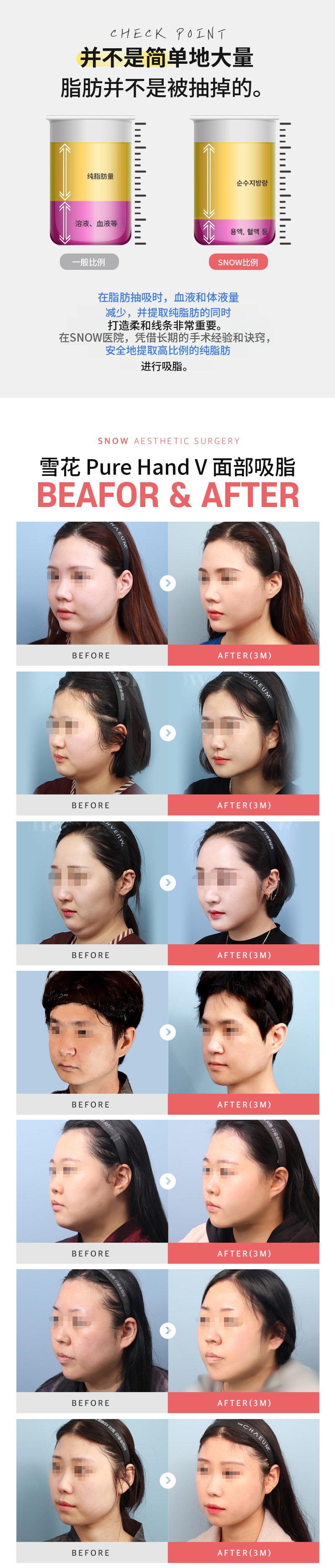 大容量面部脂肪抽吸