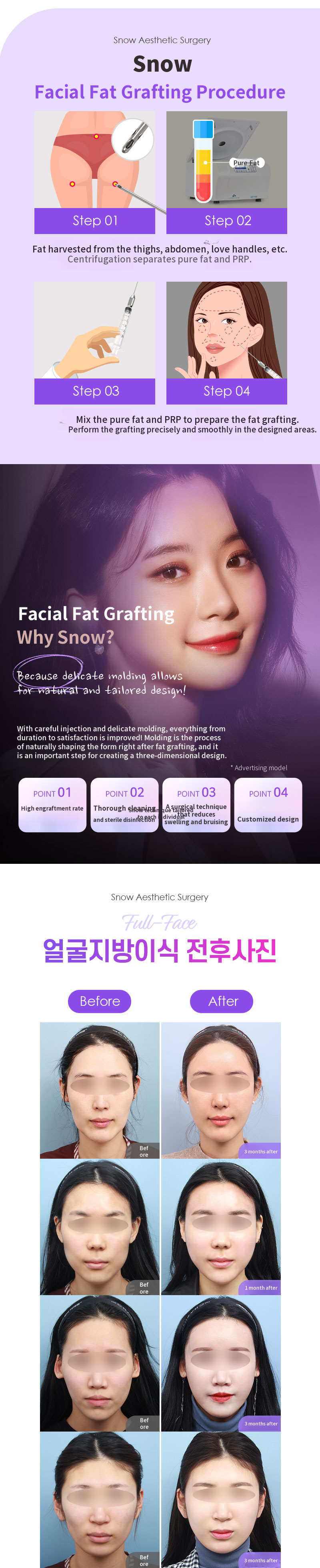 PRP Facial Fat Grafting