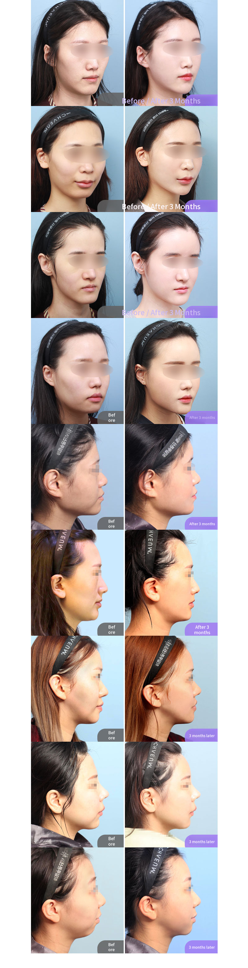 PRP Facial Fat Grafting