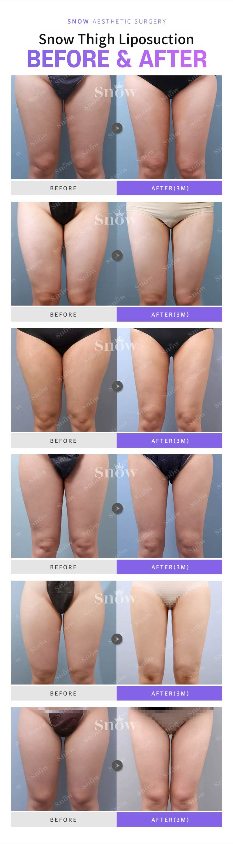 Large Volume Thigh Liposuction
