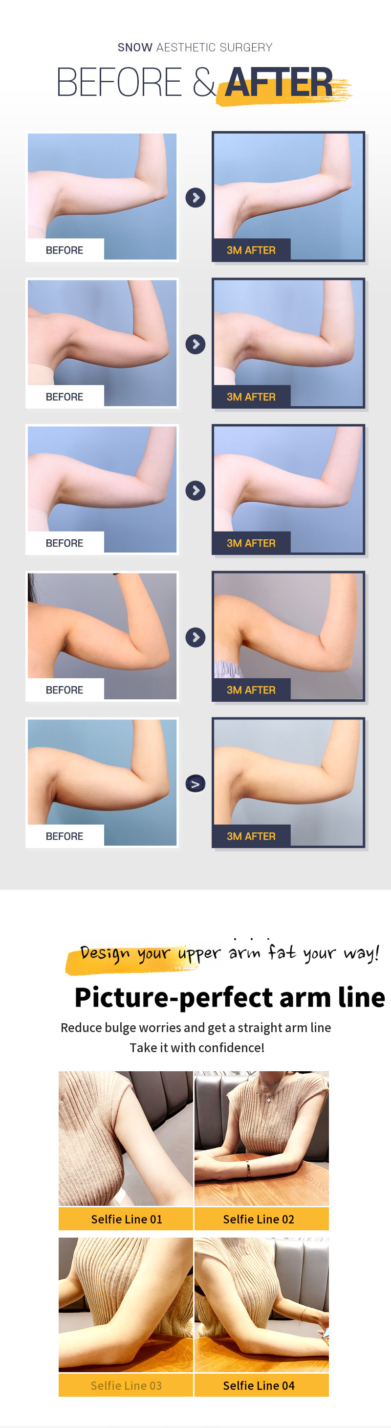 Large Volume Arm Liposuction