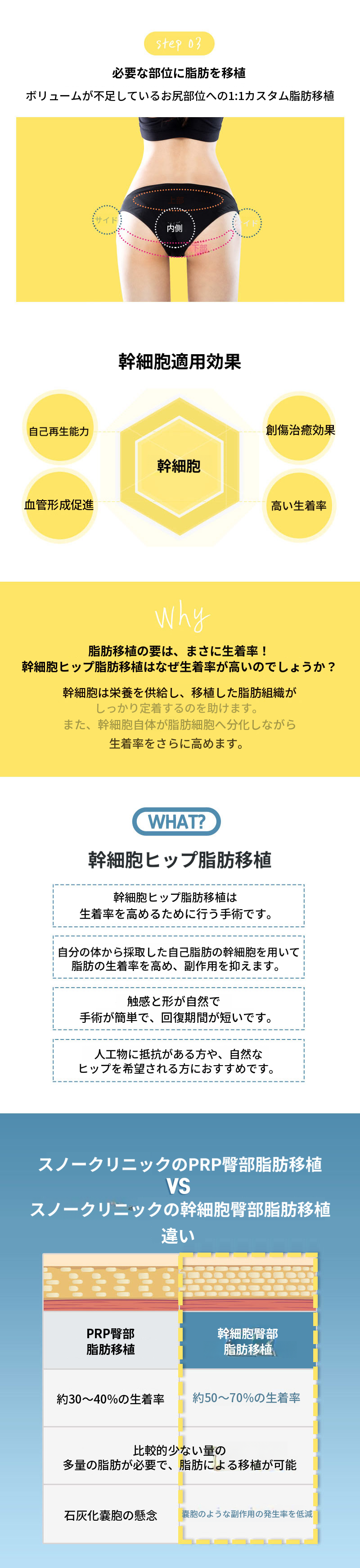 幹細胞ヒップアップお尻脂肪移植