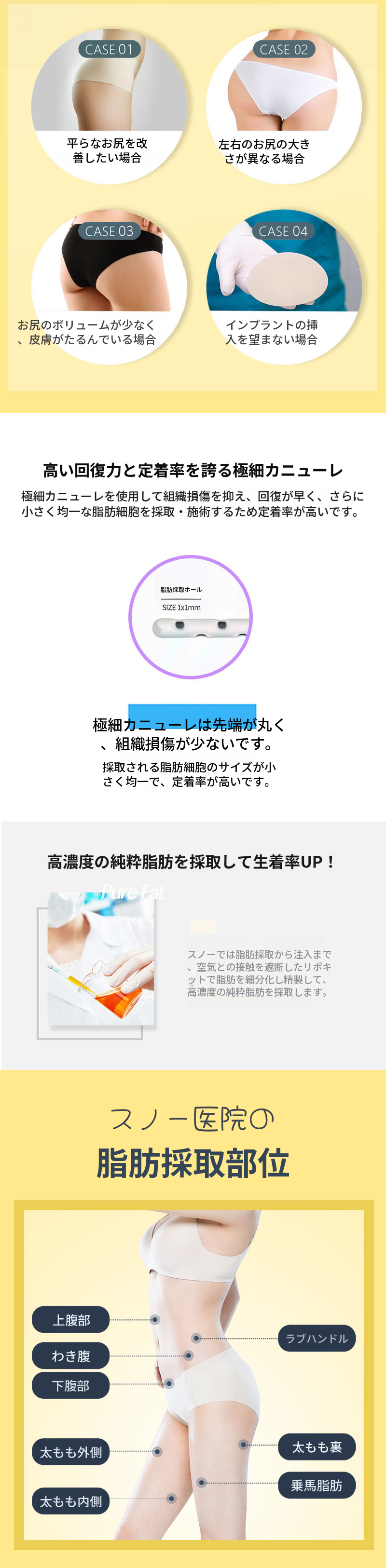 幹細胞ヒップアップお尻脂肪移植