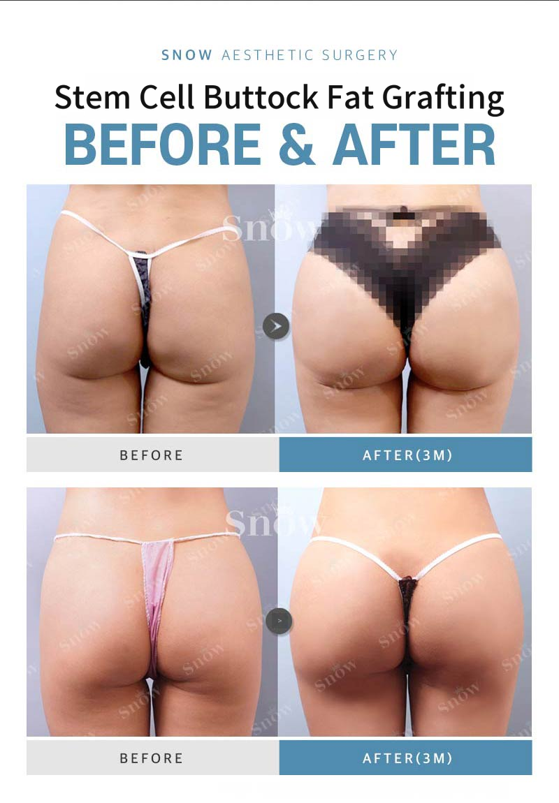 Stem Cell Butt Lift Fat Grafting
