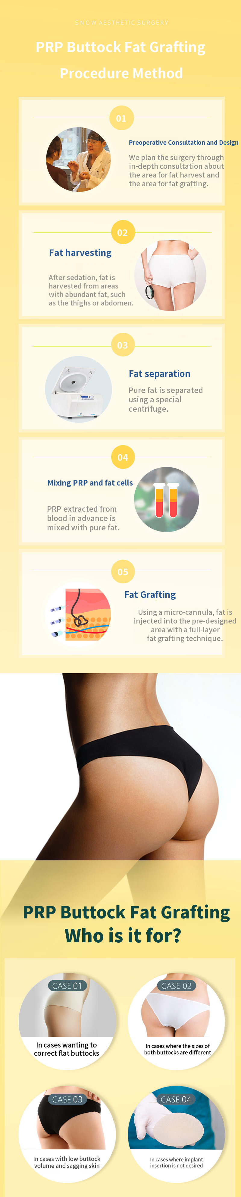 Hip Up PRR Buttock Fat Grafting