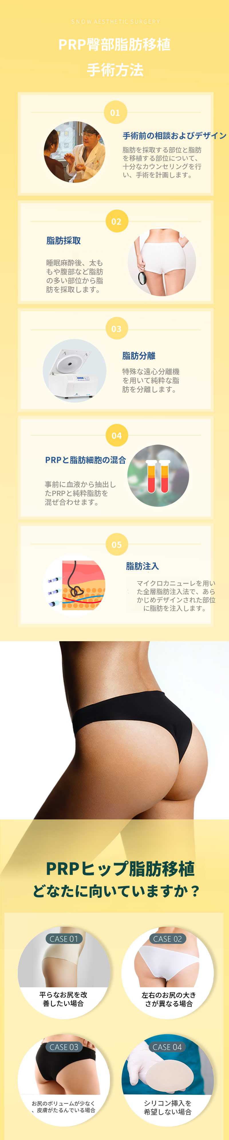 ヒップアップPRR お尻脂肪移植