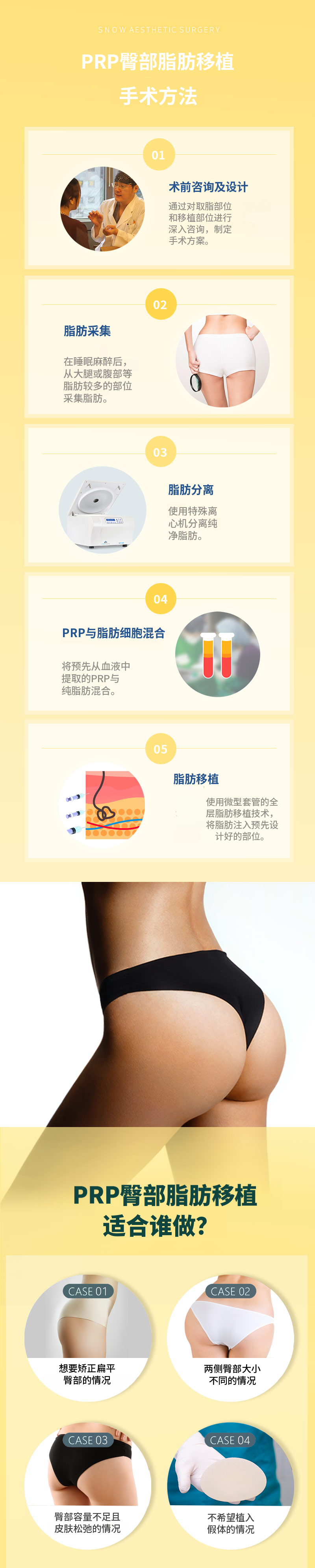 提臀PRR脂肪移植