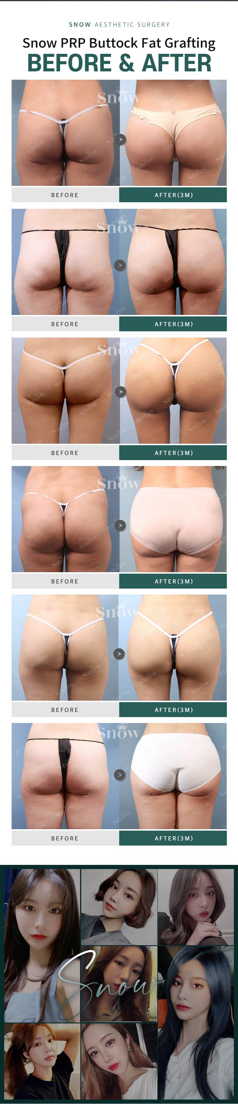 Hip Up PRR Buttock Fat Grafting