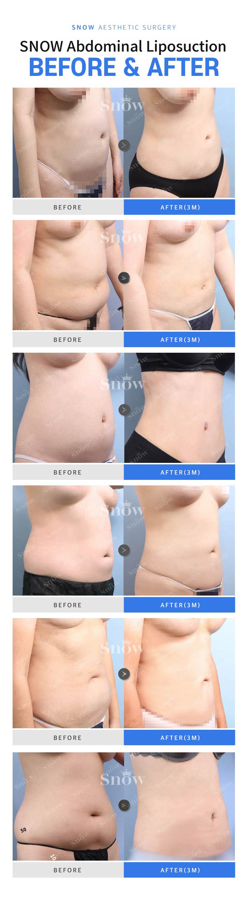 Large Volume Abdominal Liposuction