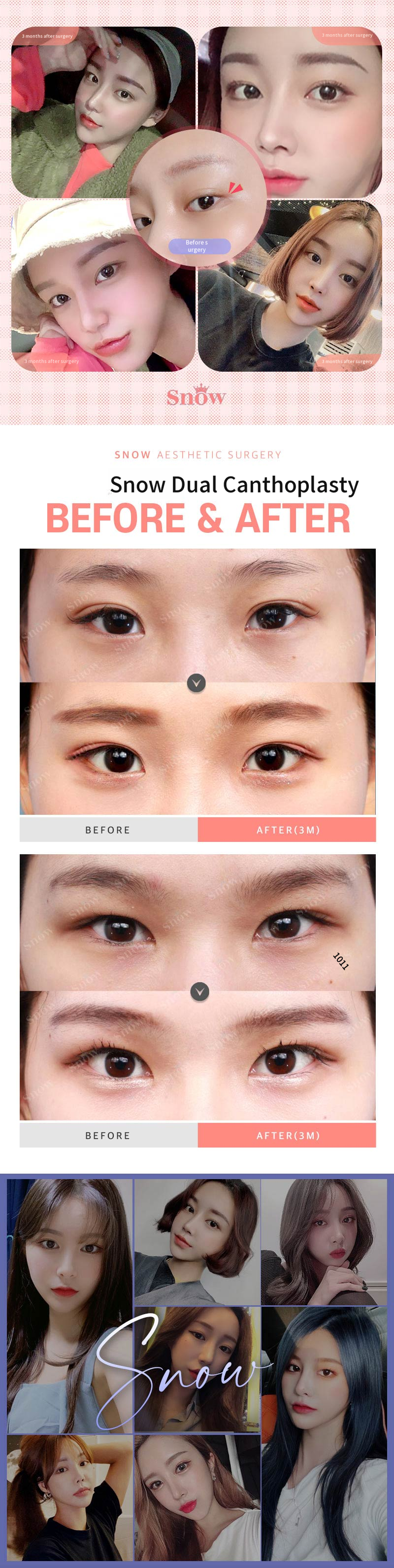 Dual Eyelid Surgery, Refreshing and Vibrant