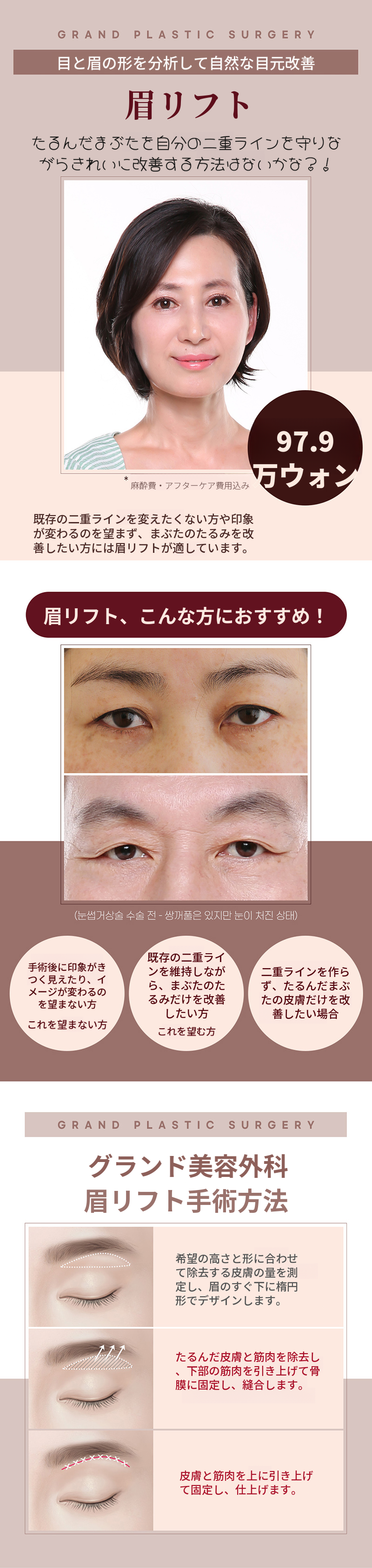 眉毛引き上げ術 たるんだまぶた改善