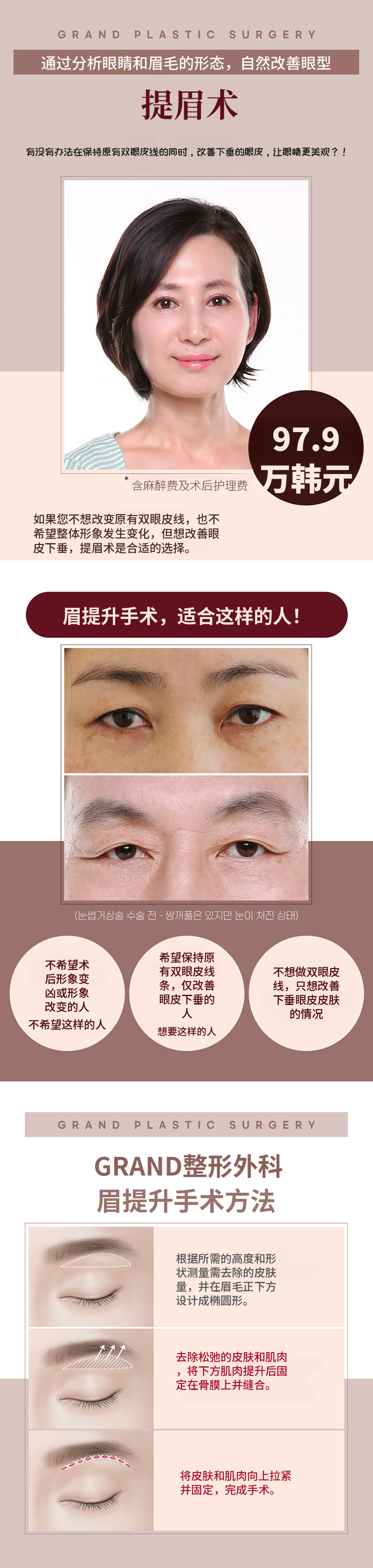 眉毛提升术改善下垂眼睑