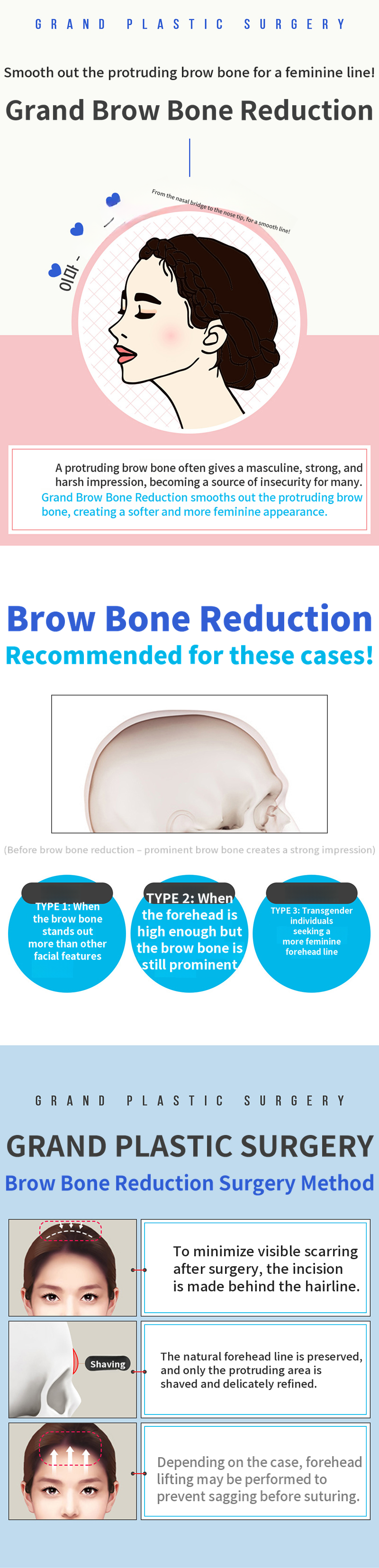 Soft Forehead Line and Eyebrow Bone Reduction