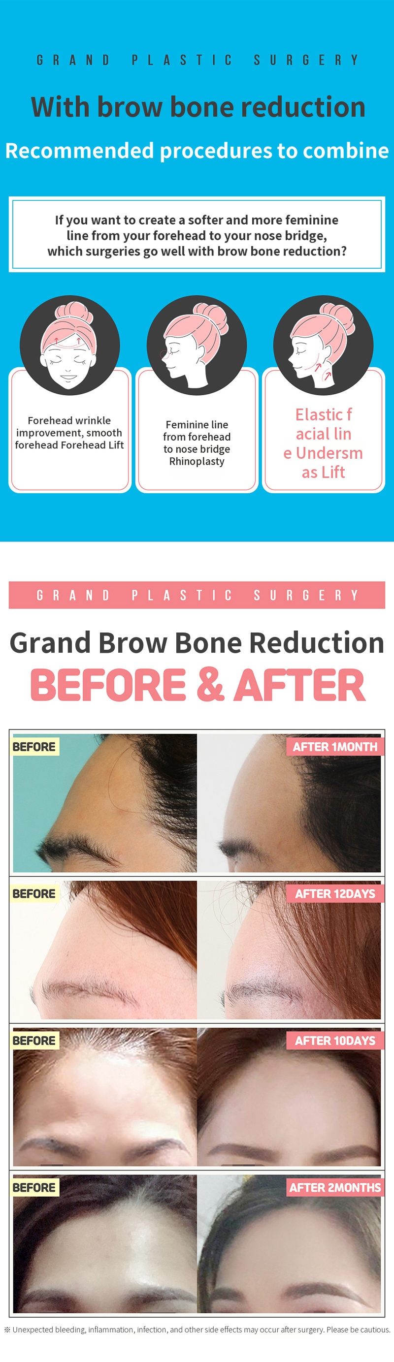 Soft Forehead Line and Eyebrow Bone Reduction