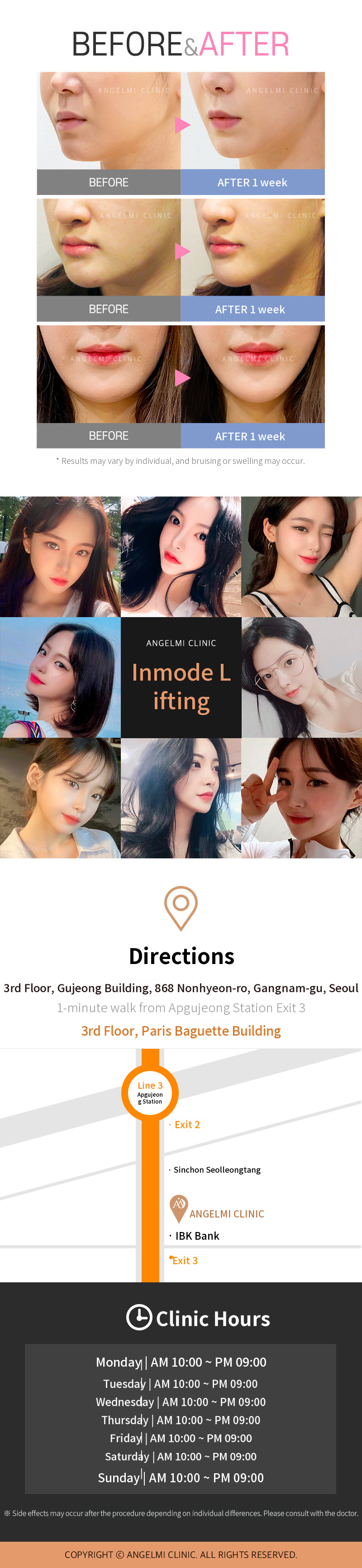 Inmode Lifting