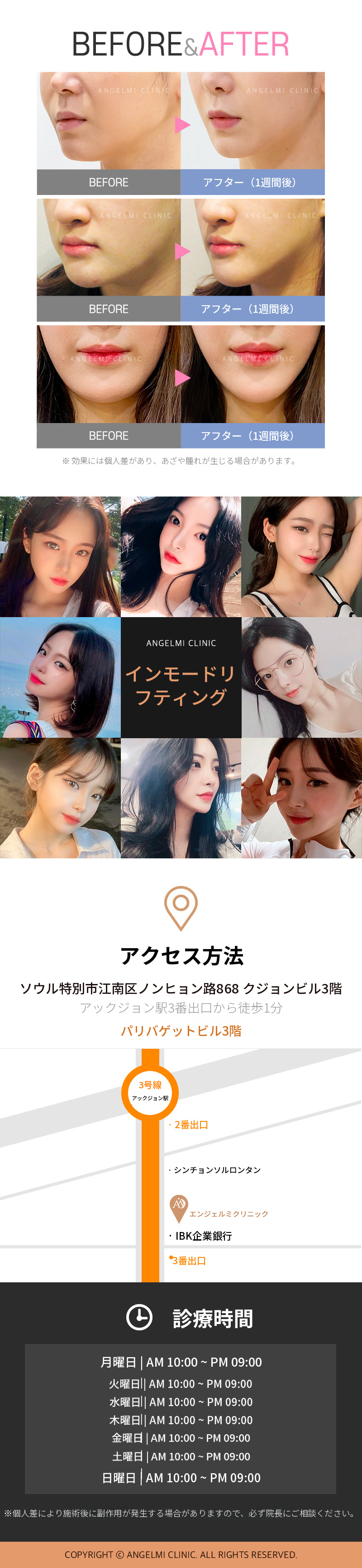 インモードリフティング