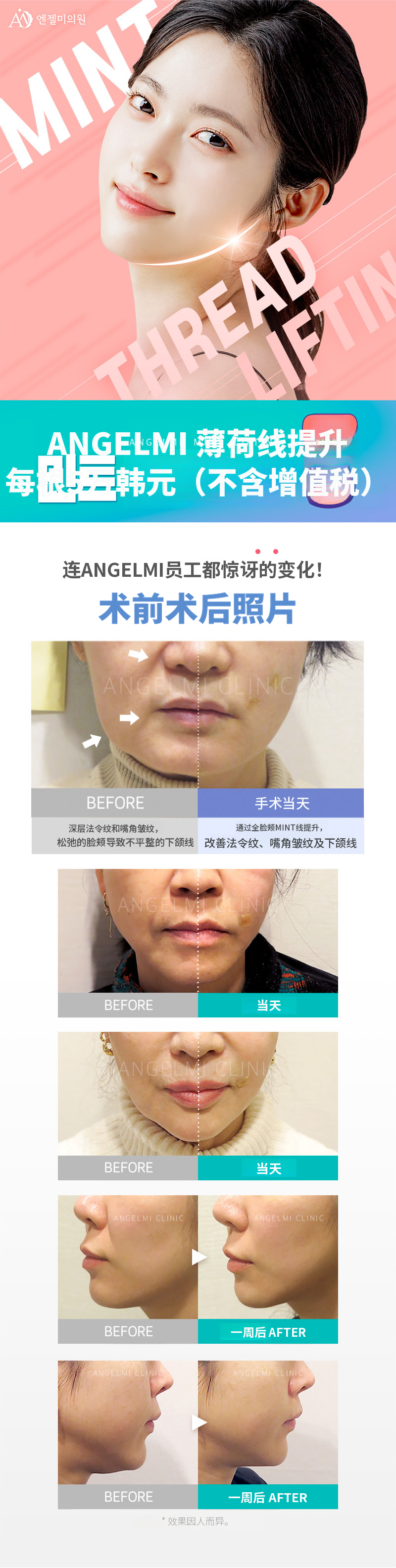 薄荷线提升