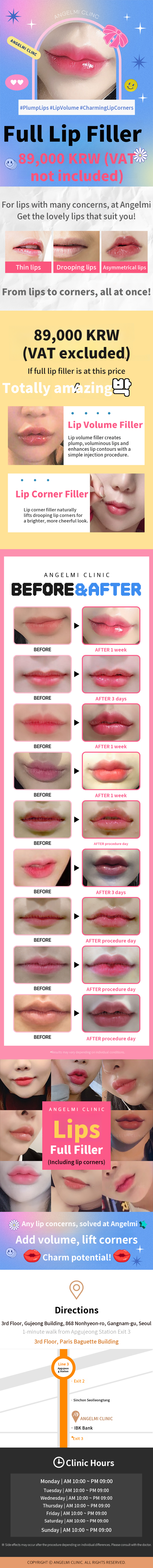 Full Lip Filler