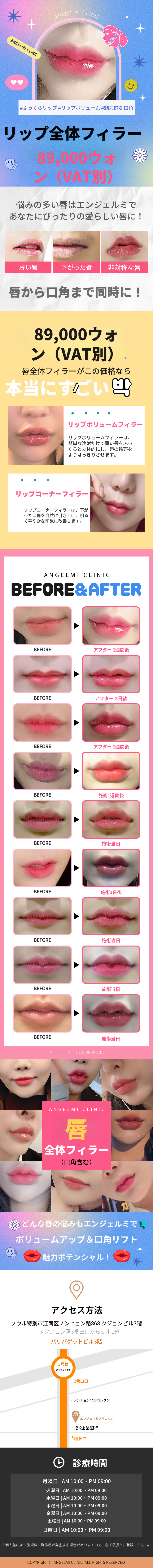 唇全体フィラー