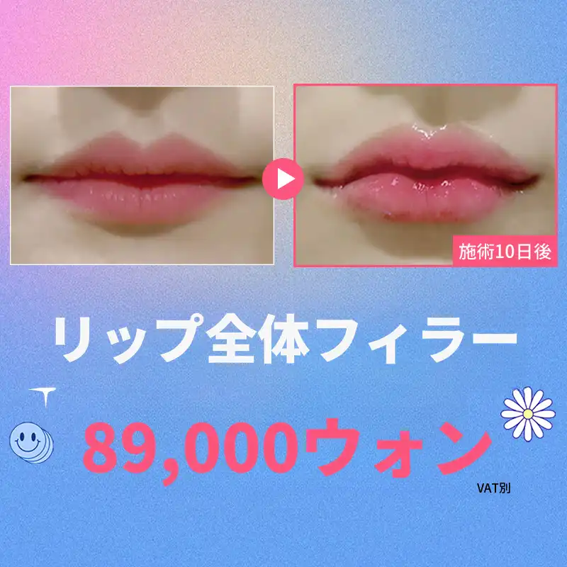 唇全体フィラー