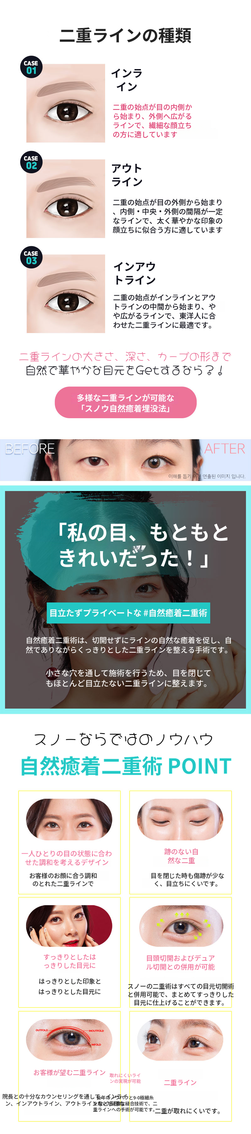 自然な自然癒着二重まぶた