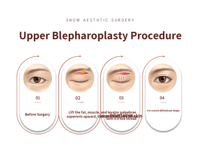 Midlife Eyelid Surgery - Upper Eyelid and Eyebrow Lift