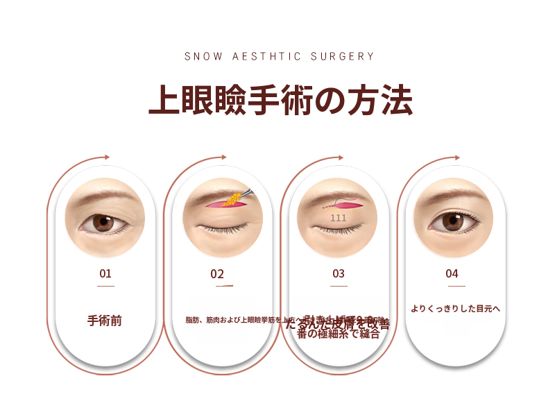 中年期まぶた形成 上眼瞼 まぶた下挙上術